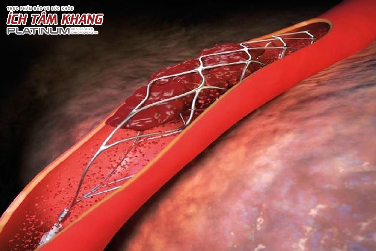 Đặt stent mạch vành là phương pháp phổ biến giúp người bệnh tái thông mạch vành